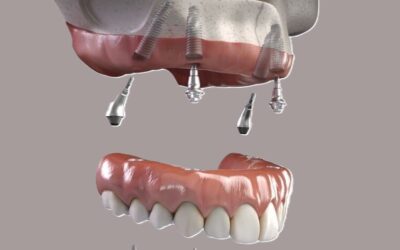 All on 4 dental implants recovery in Marvin and Waxhaw NC