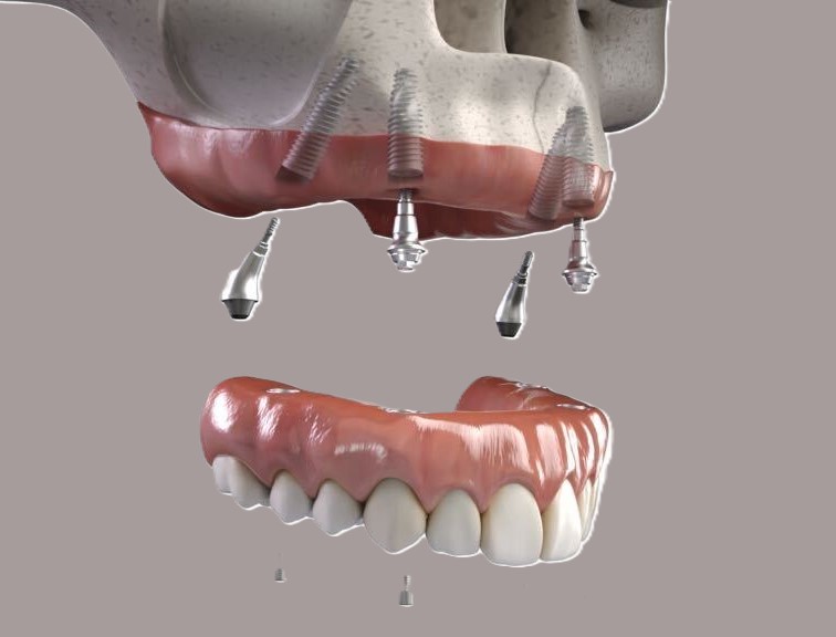 All on 4 dental implants