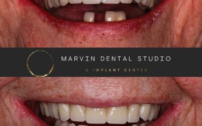 Emergency dental in Marvin and Warshaw NC to Protect Smiles