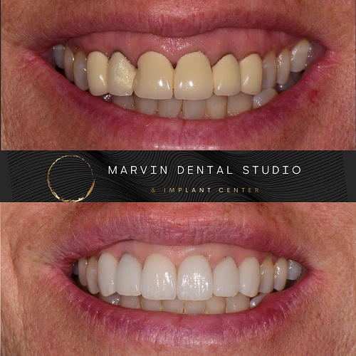 Professional teeth whitening at the dentist at Marvin and Waxhaw NC