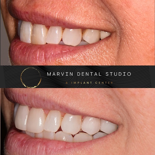 Professional Teeth Whitening